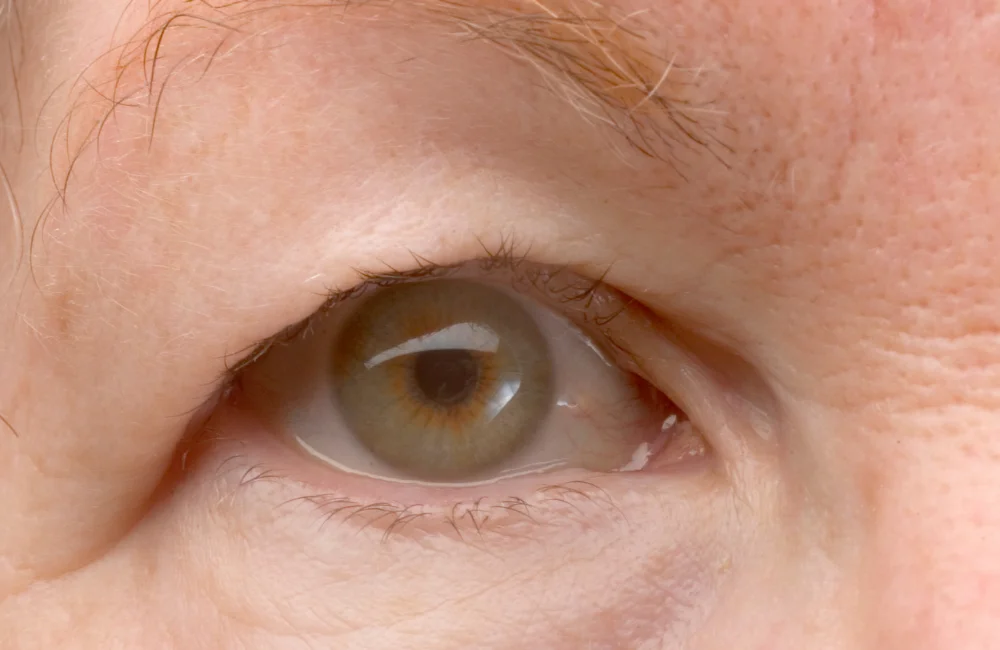 หนังตาตกในผู้สูงอายุ