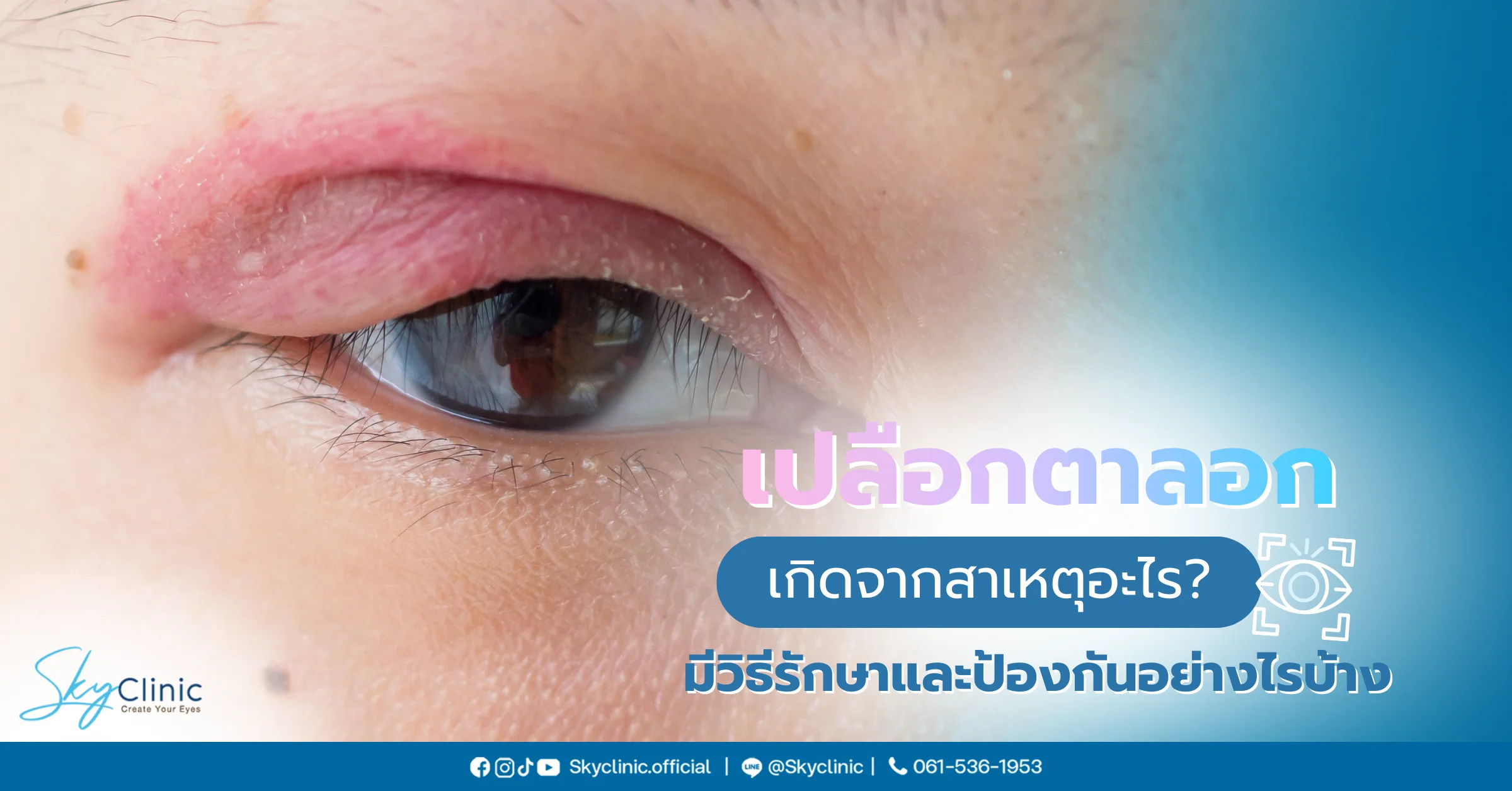 เปลือกตาลอก