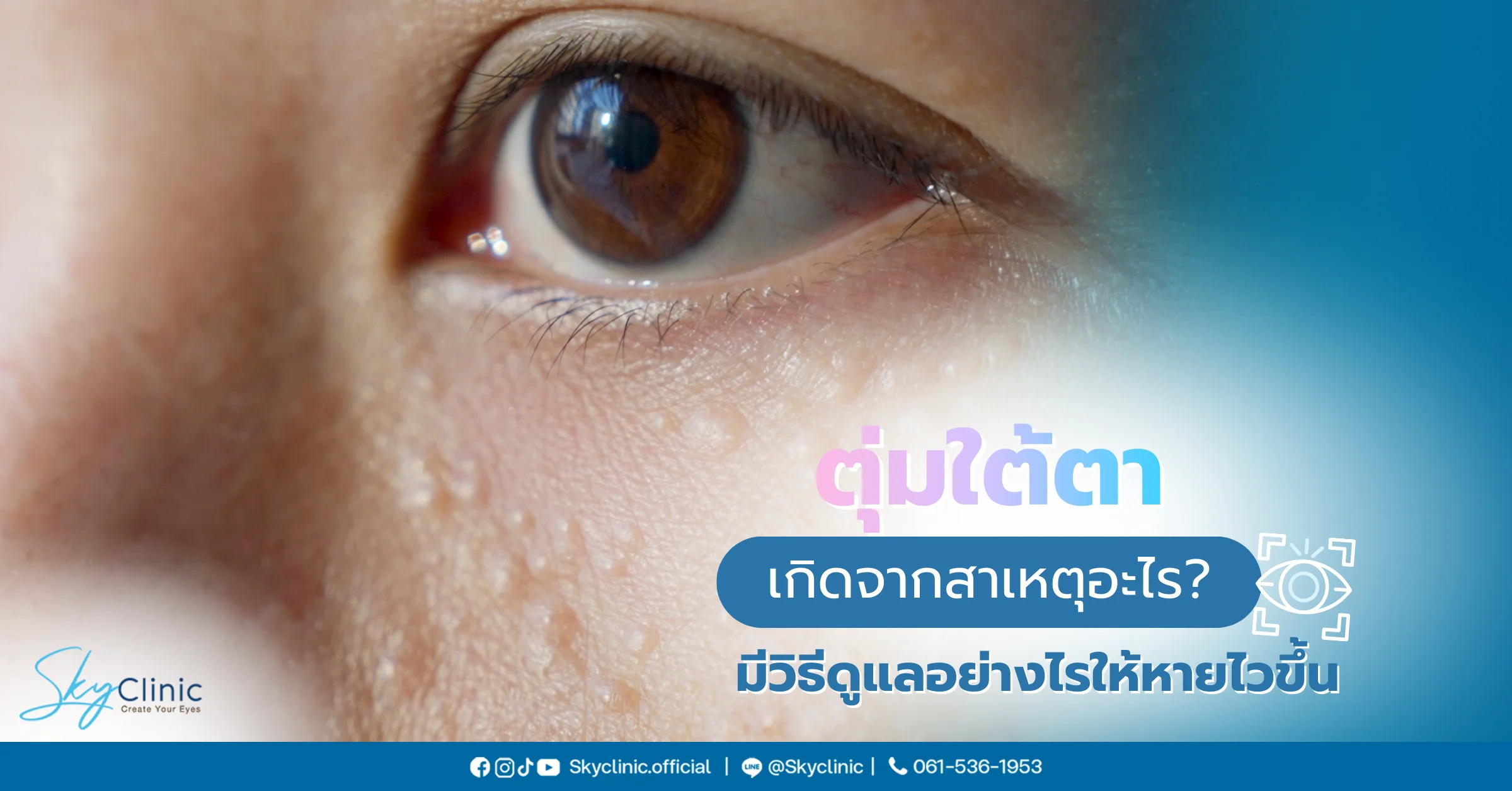 ตุ่มใต้ตา