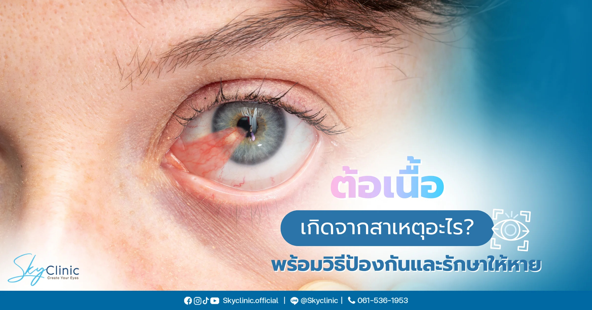 ต้อเนื้อ