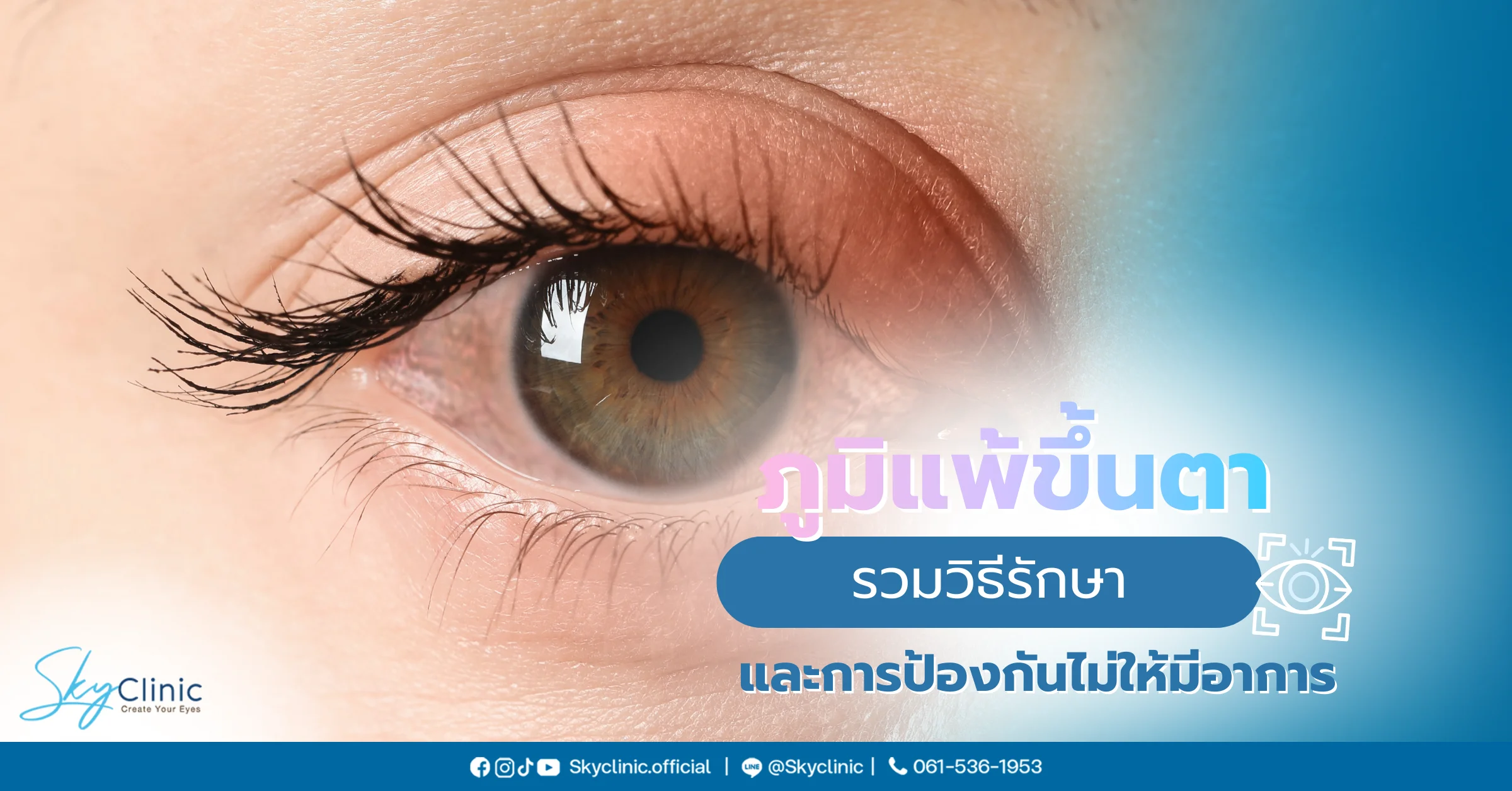 ภูมิแพ้ขึ้นตา