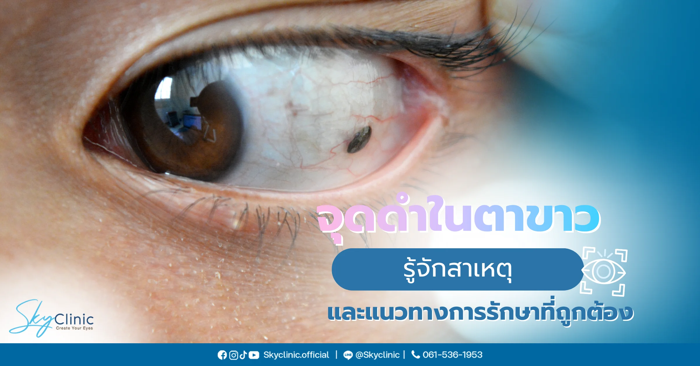 จุดดำในตาขาว