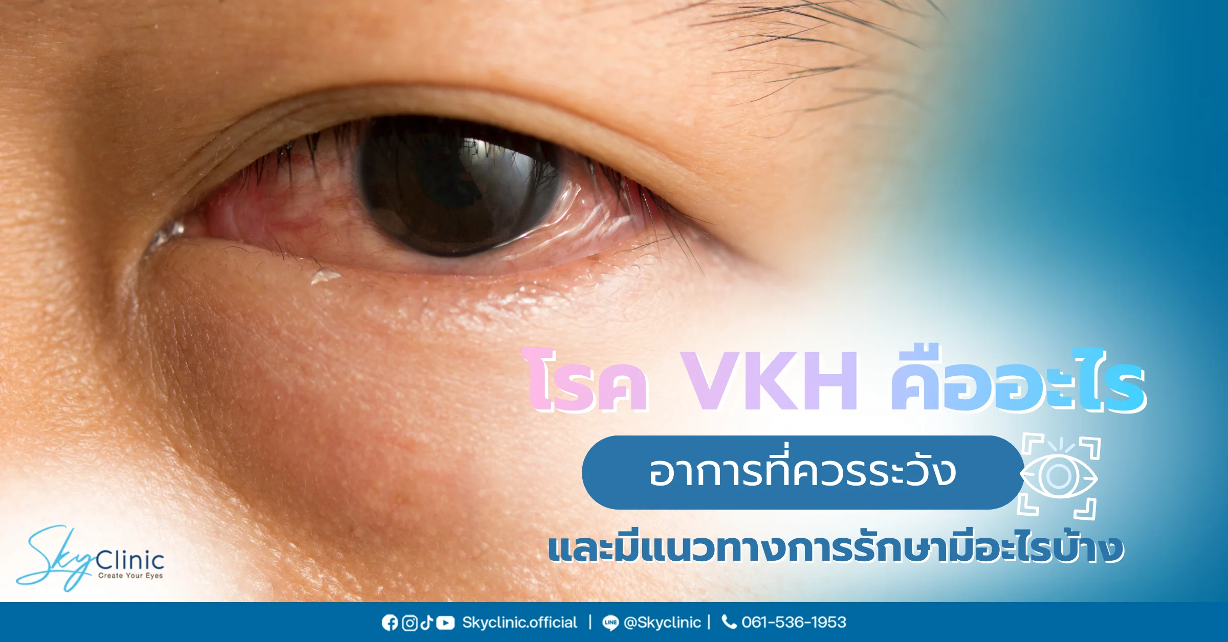 โรค VKH คืออะไร