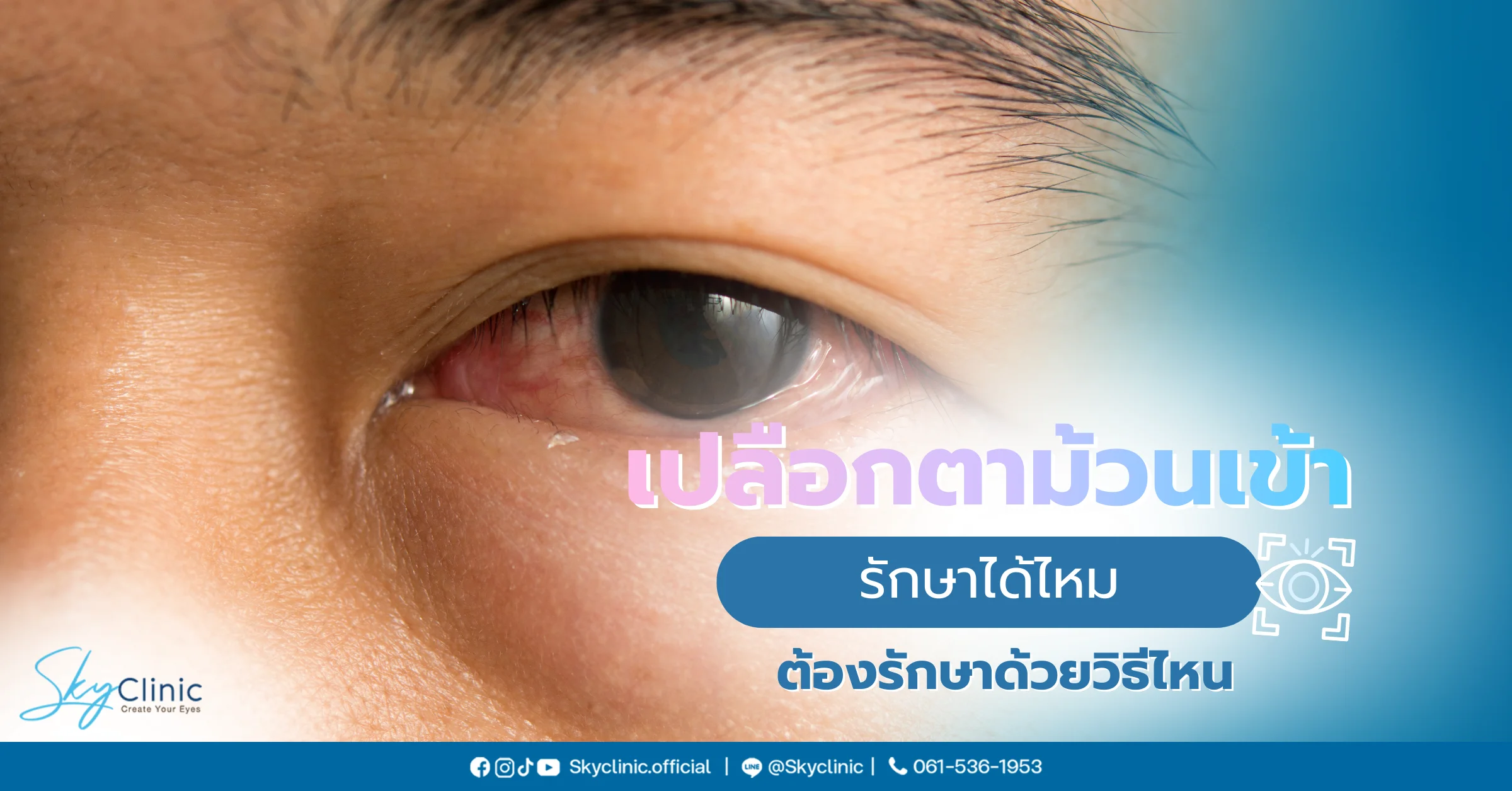 เปลือกตาม้วนเข้า รักษาได้ไหม? รวมสาเหตุและวิธีแก้ไข