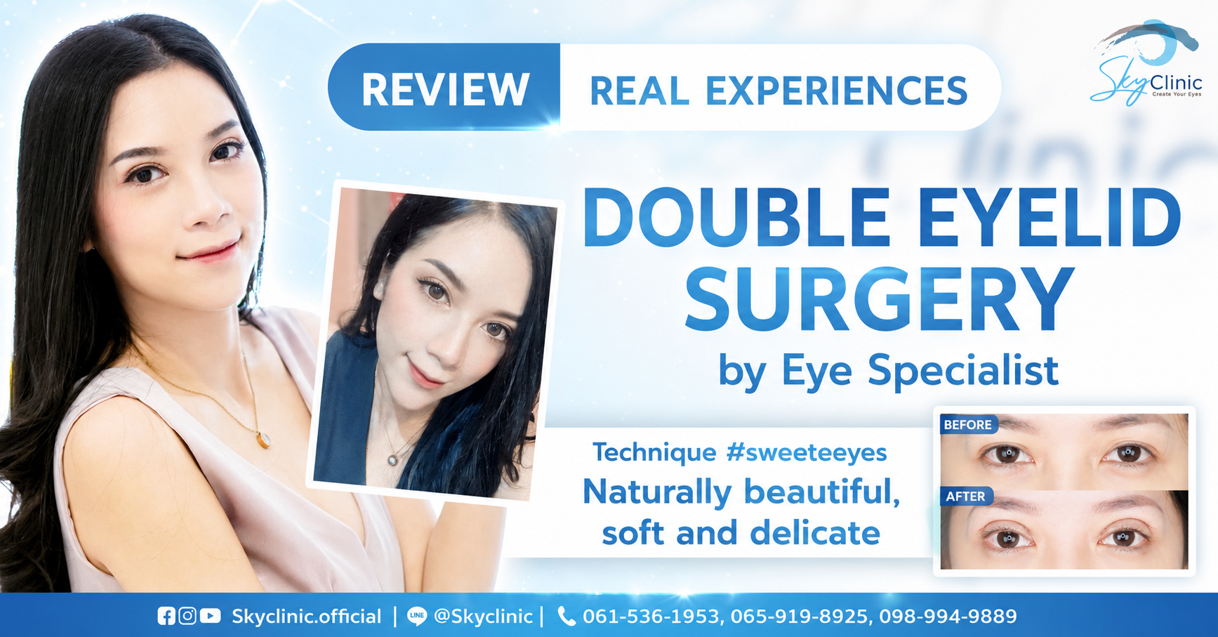 Review of Nong Namfon's experience of getting double eyelid surgery by Dr. Sky