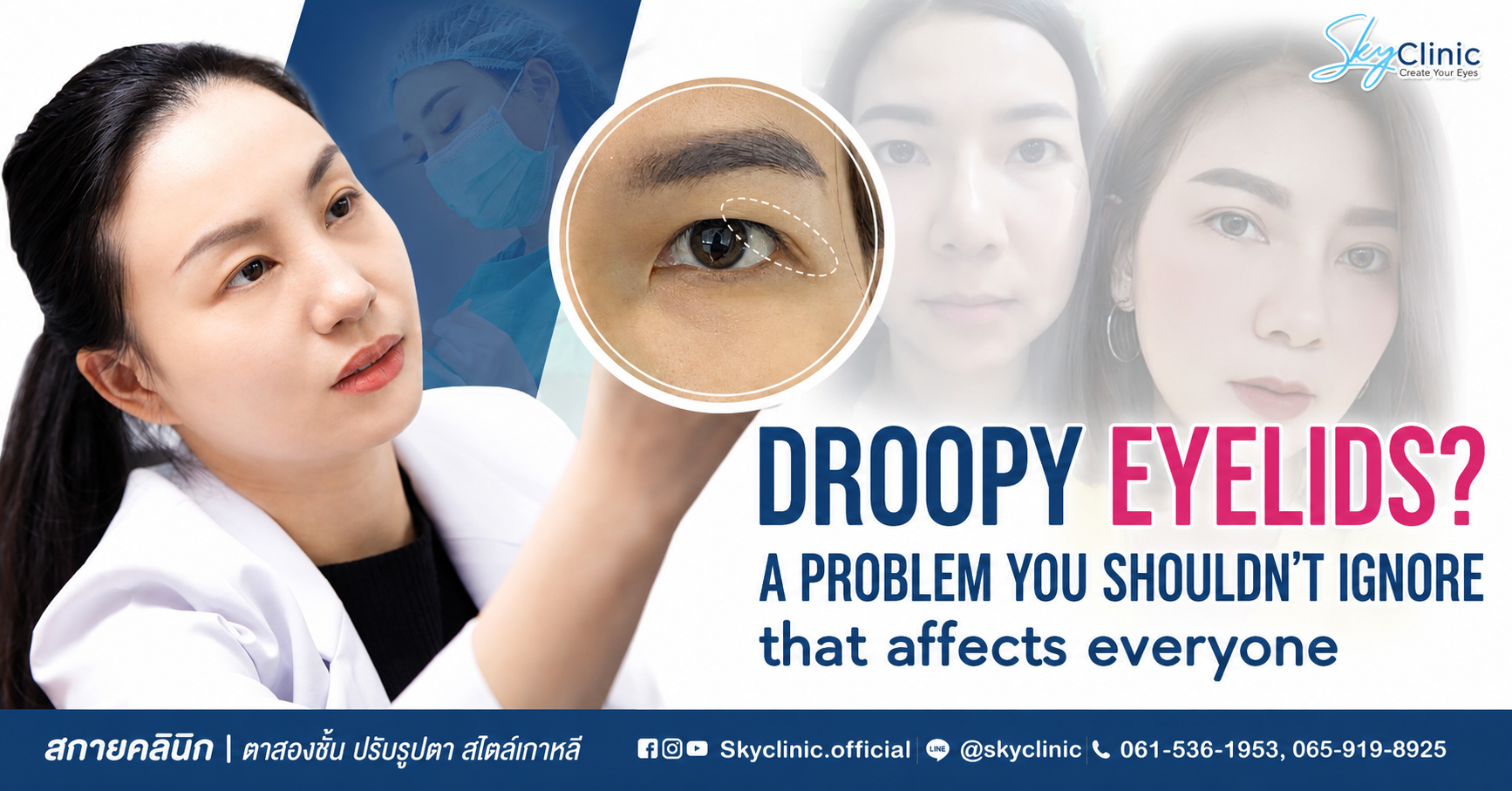 ปัญหาตาดูง่วง ตาตก ทำให้หน้าโทรม ผ่าตัดแก้หนังตาตกช่วยได้