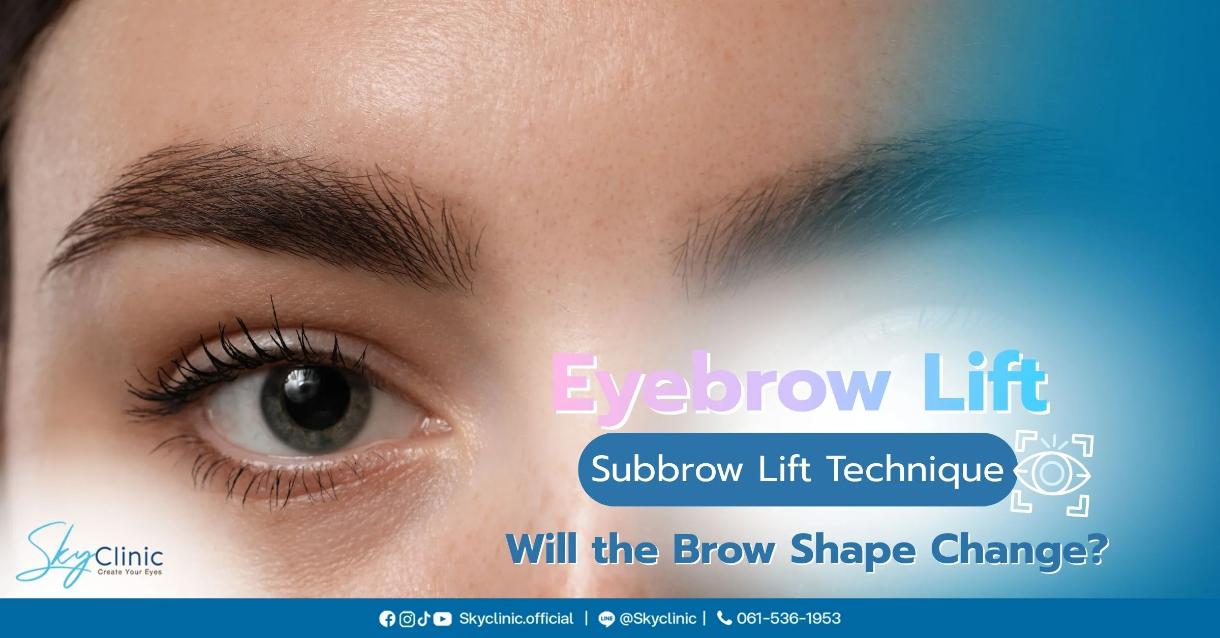 Subbrow Lift