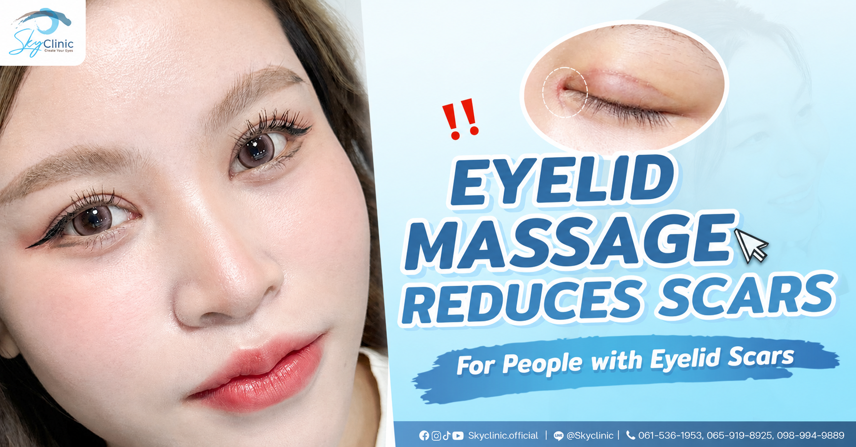How to massage your eyes to reduce keloids