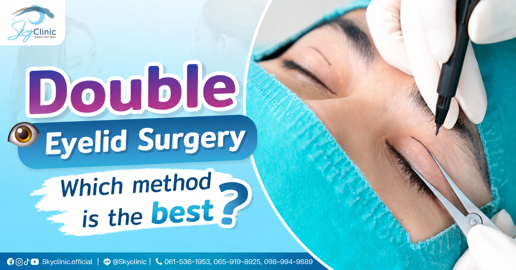 How many levels of bruising are there after double eyelid surgery?