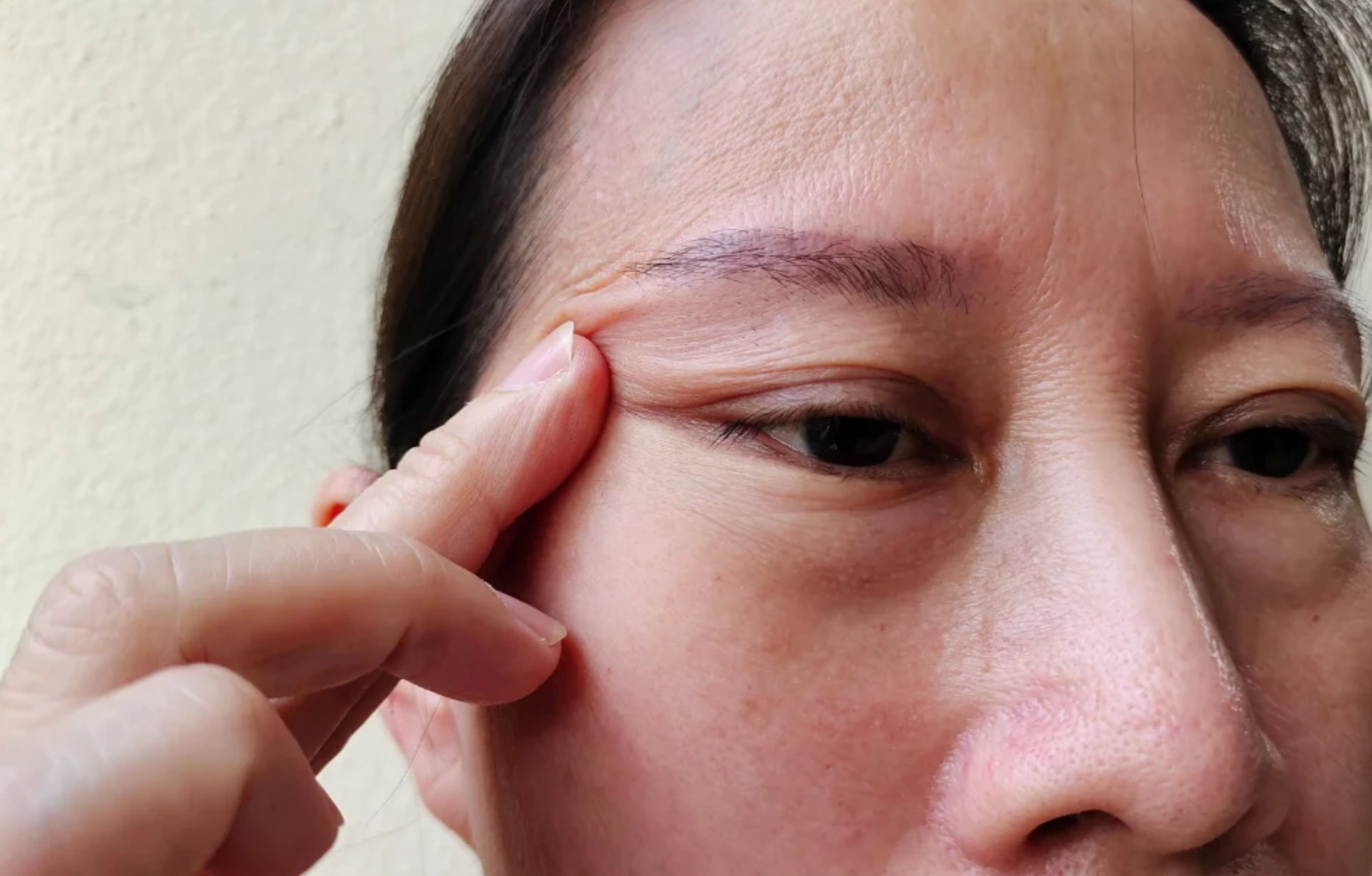 ลักษณะของ Ptosis