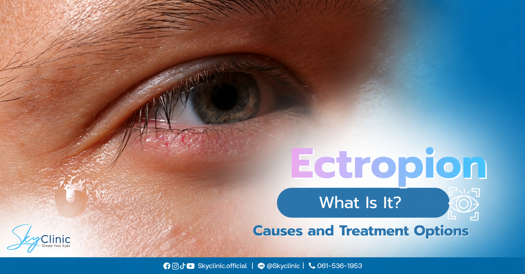 ตาปลิ้น Ectropion