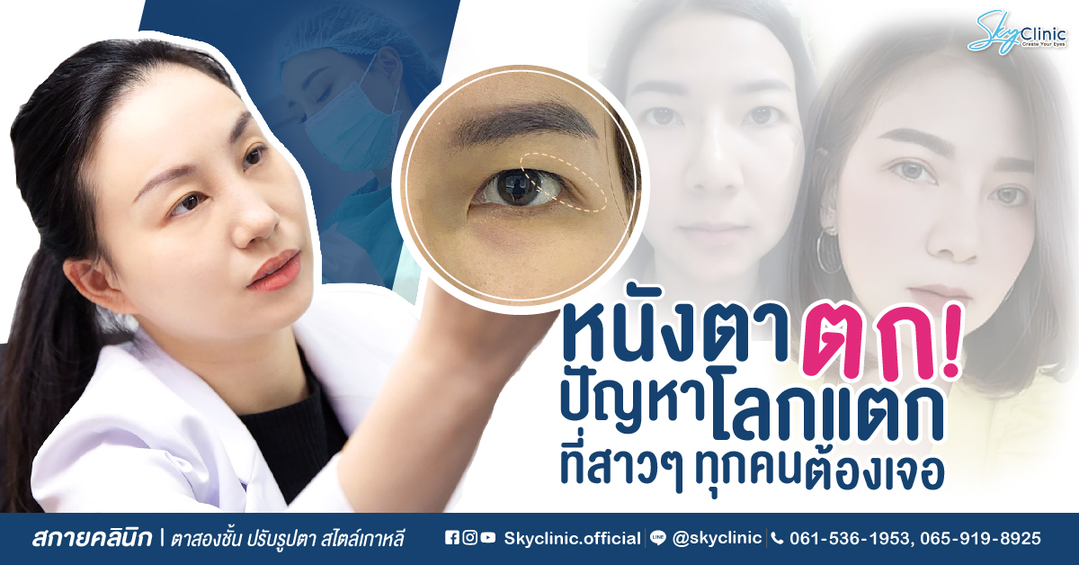 ปัญหาตาดูง่วง ตาตก ทำให้หน้าโทรม ผ่าตัดแก้หนังตาตกช่วยได้