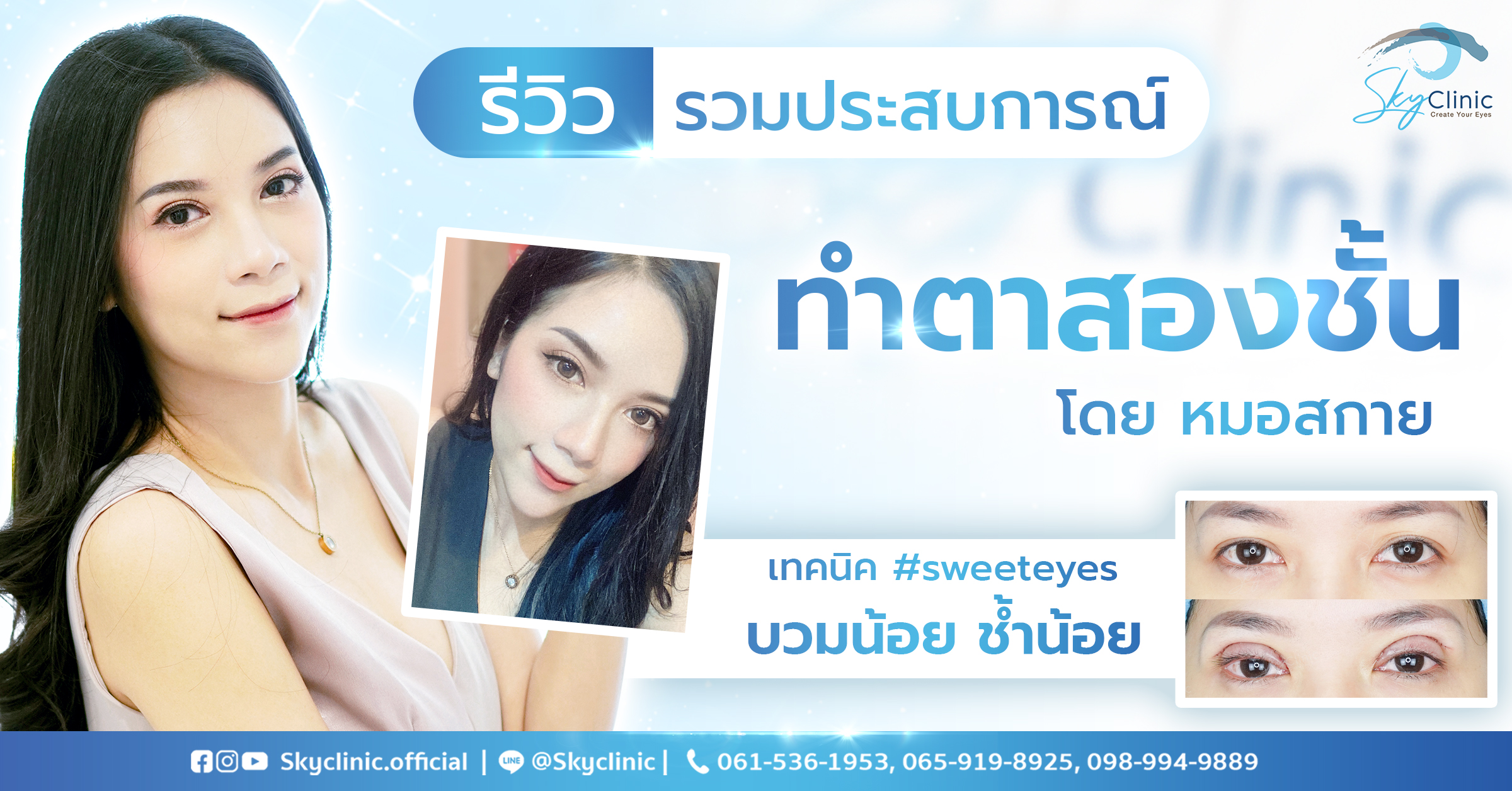 รีวิวประสบการณ์ทำตาสองชั้นโดยหมอสกาย ของน้องน้ำฝน