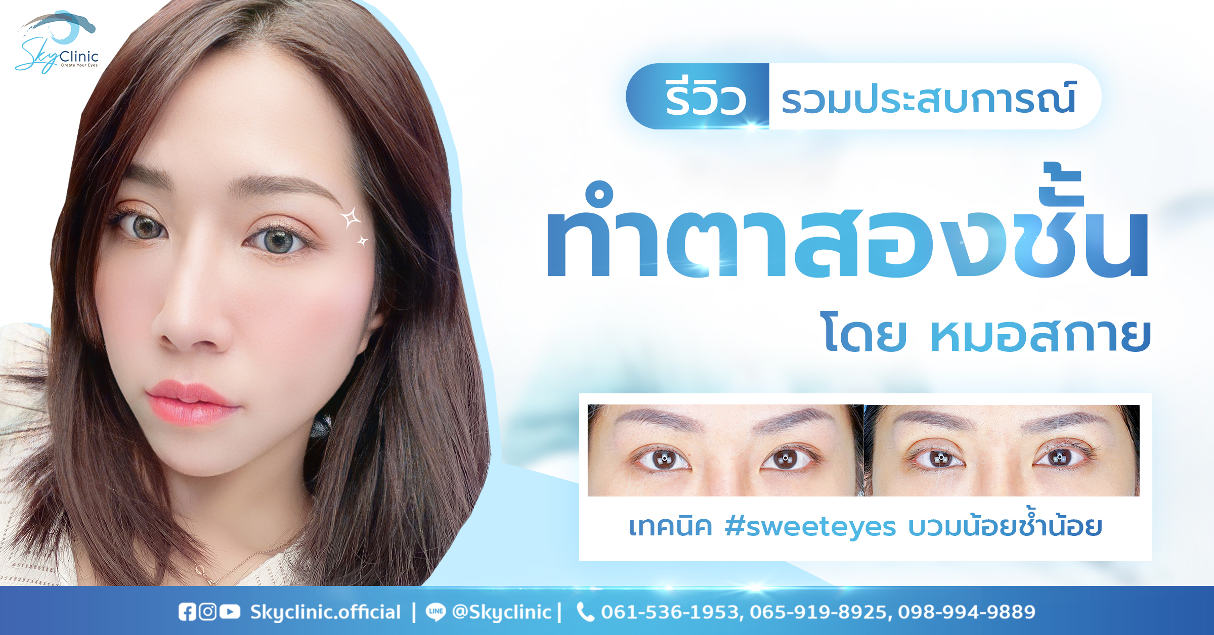 รีวิวรวมประสบการณ์ทำตาสองชั้นโดยหมอสกาย ของน้องแอม