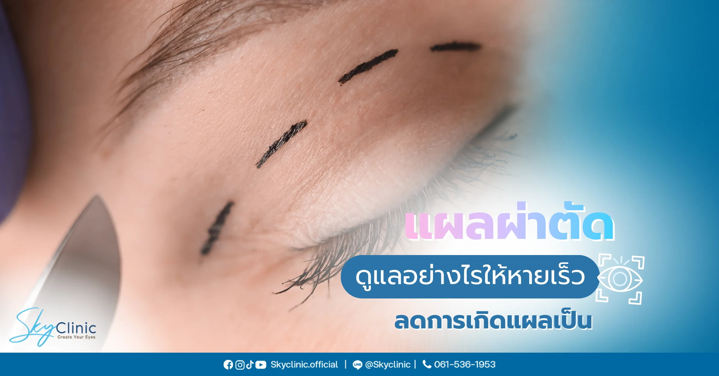 แผลผ่าตัดกี่วันหาย