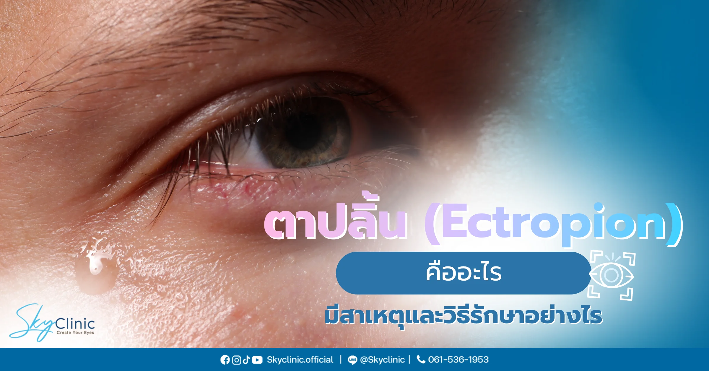ตาปลิ้น Ectropion