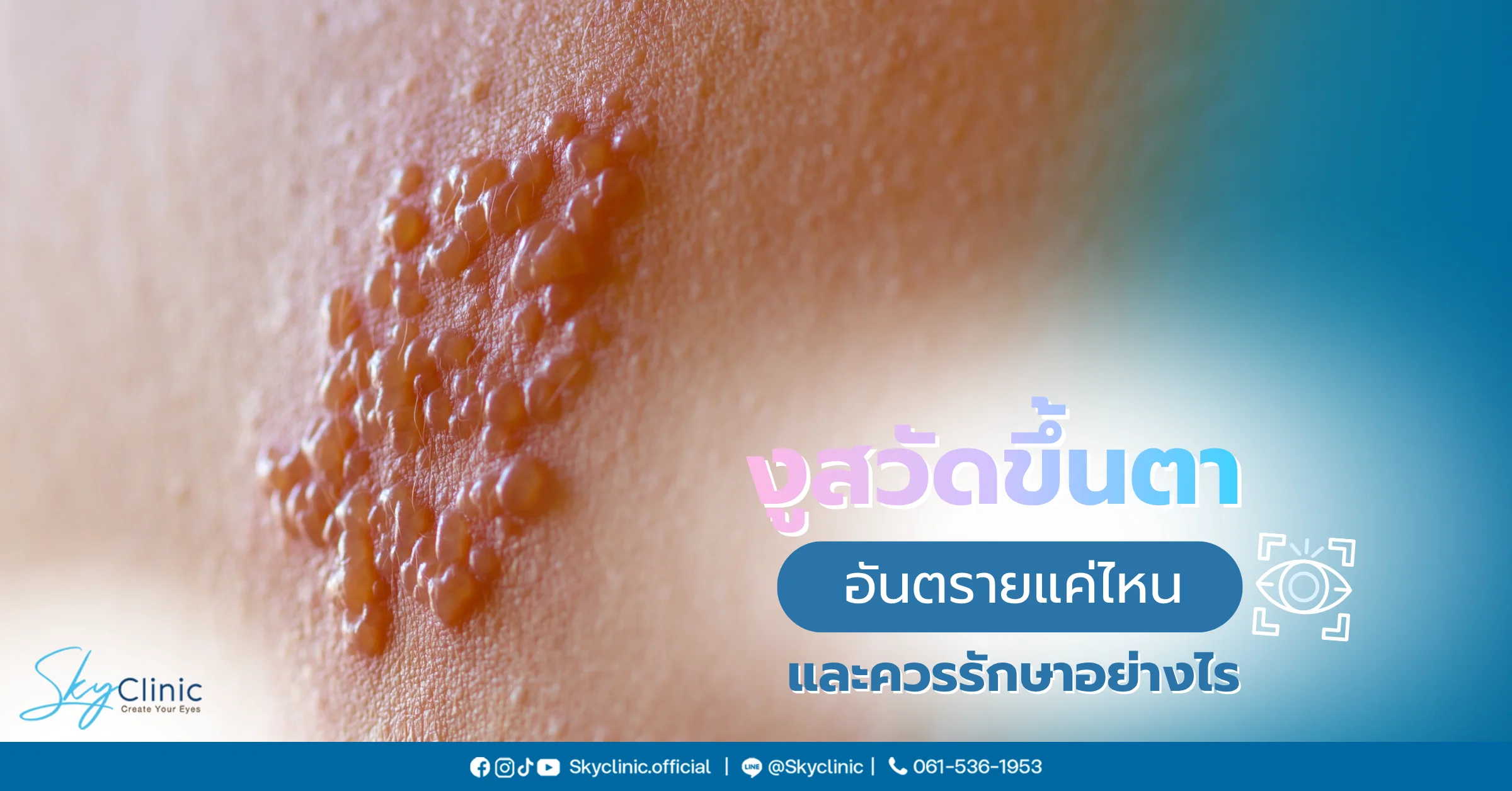 งูสวัดขึ้นตา