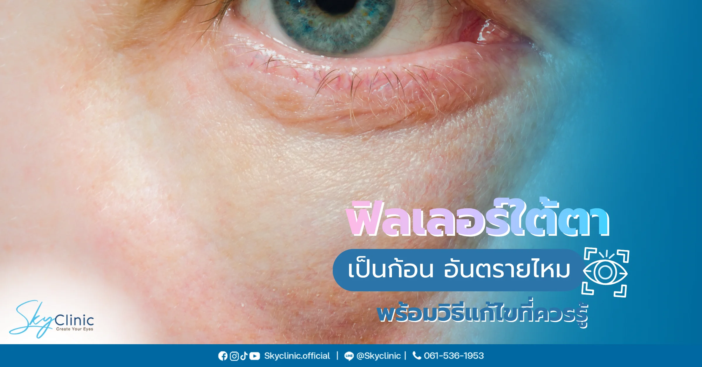 ฟิลเลอร์ใต้ตาเป็นก้อน