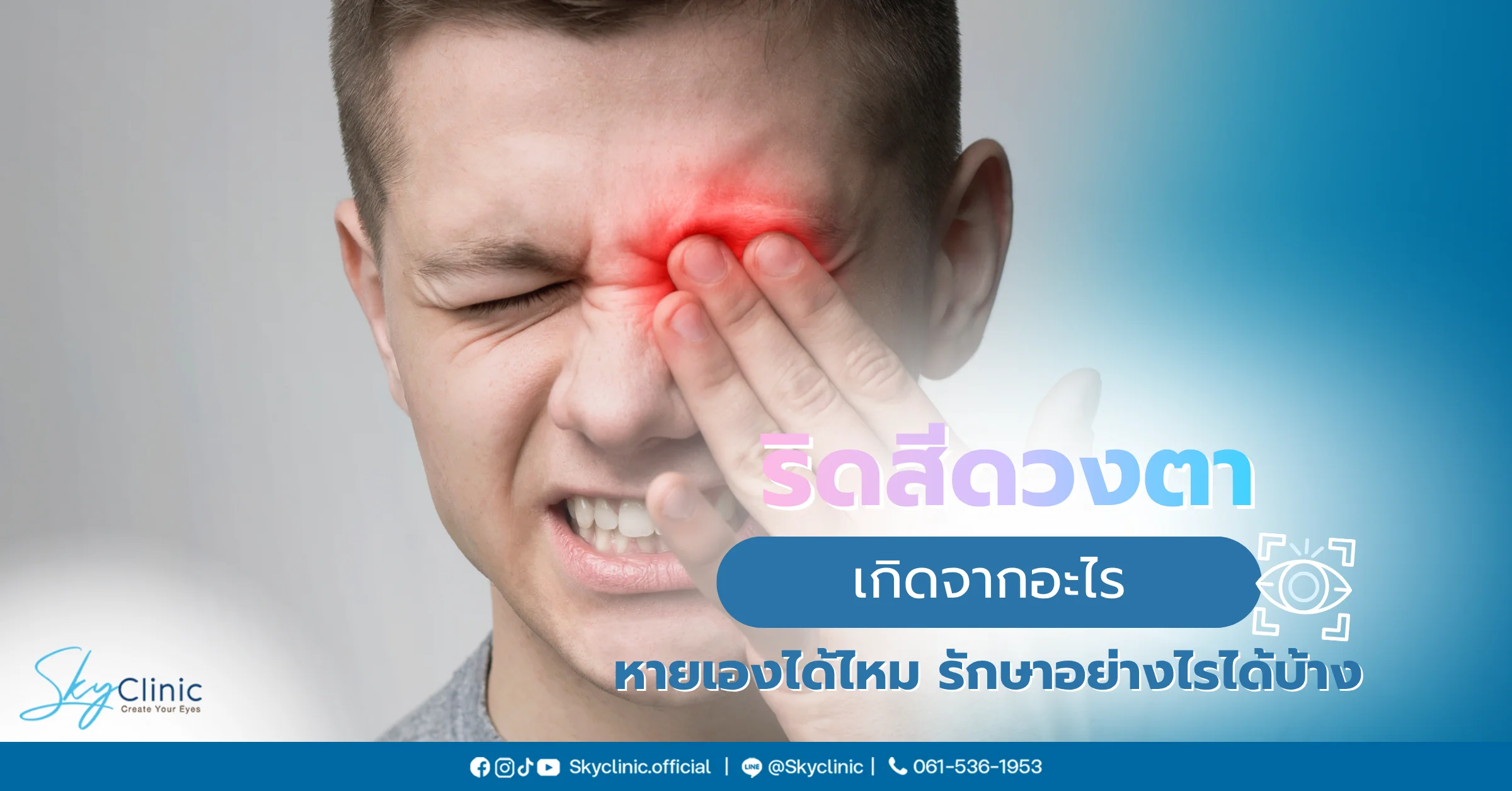 ริดสีดวงตา