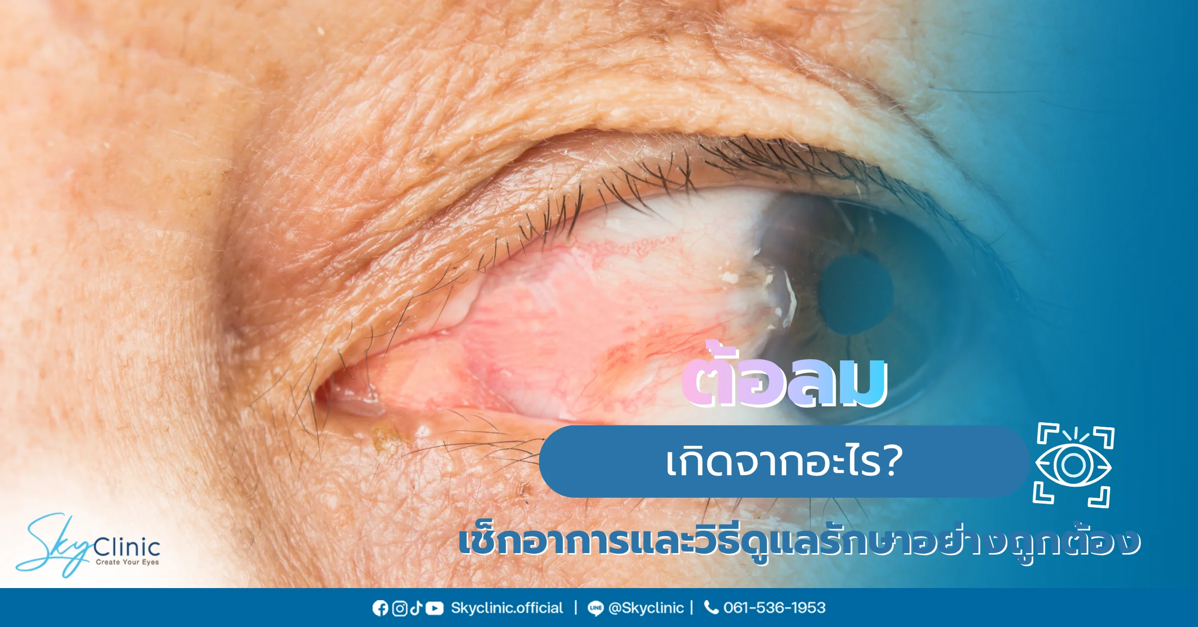 ต้อลม