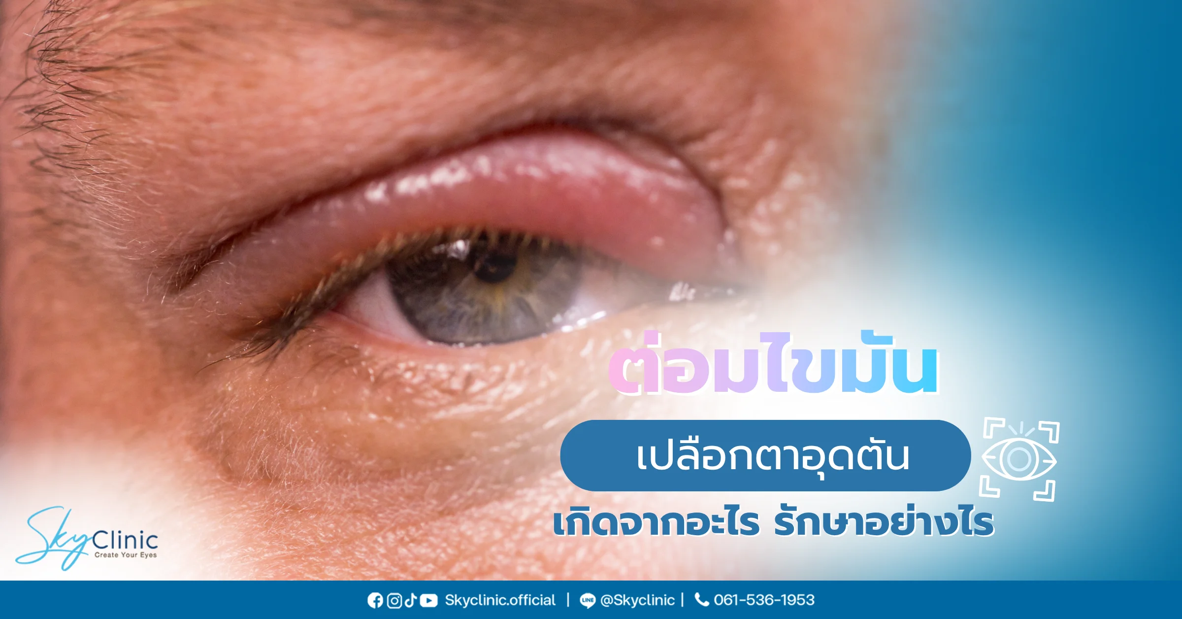 ต่อมไขมันเปลือกตาอุดตัน