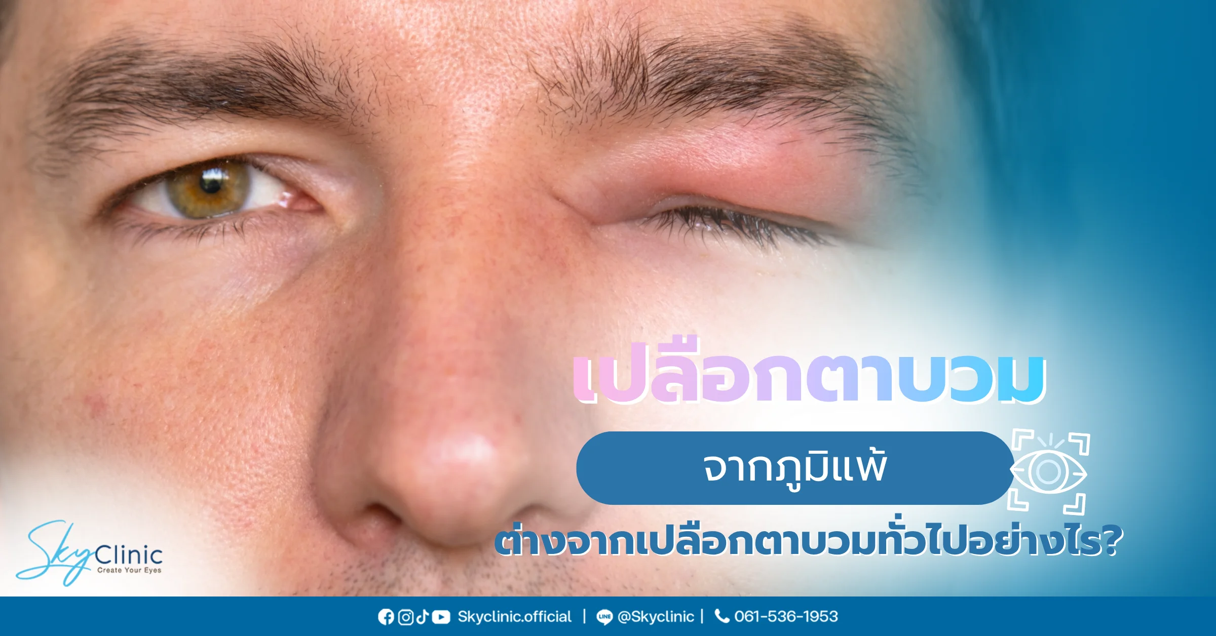 เปลือกตาบวมจากภูมิแพ้
