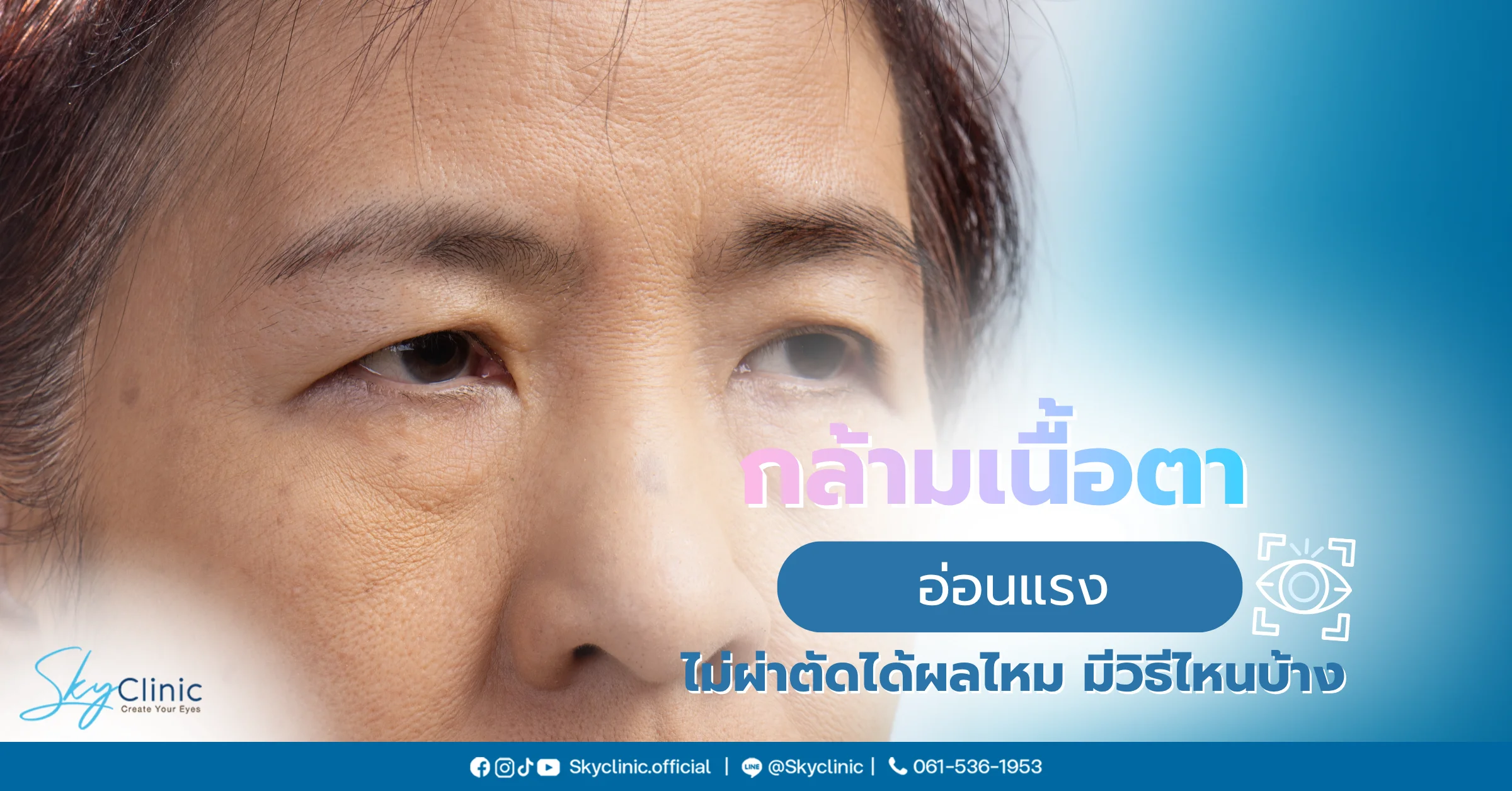 กล้ามเนื้อตาอ่อนแรง