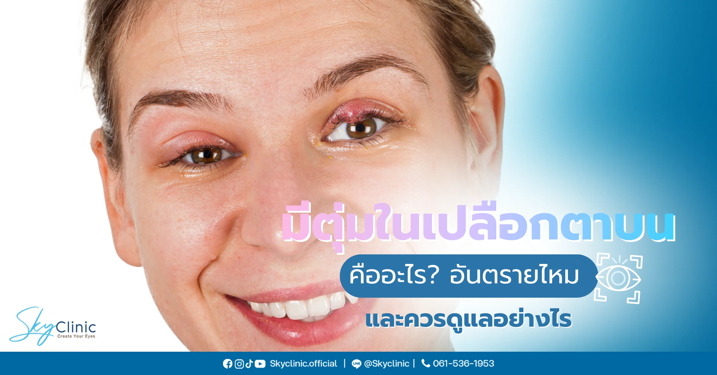 ตุ่มในเปลือกตาบน