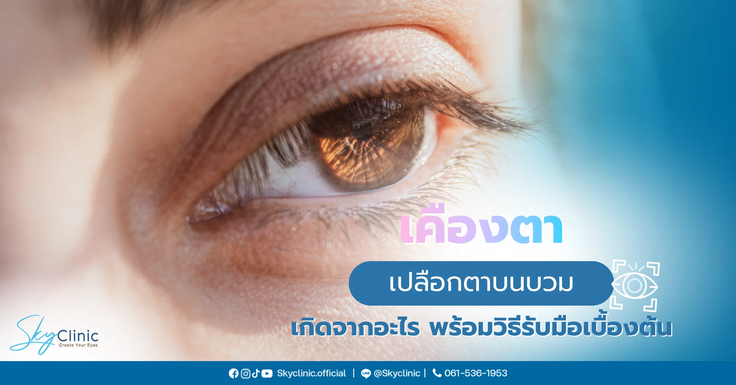 เปลือกตาบนบวม