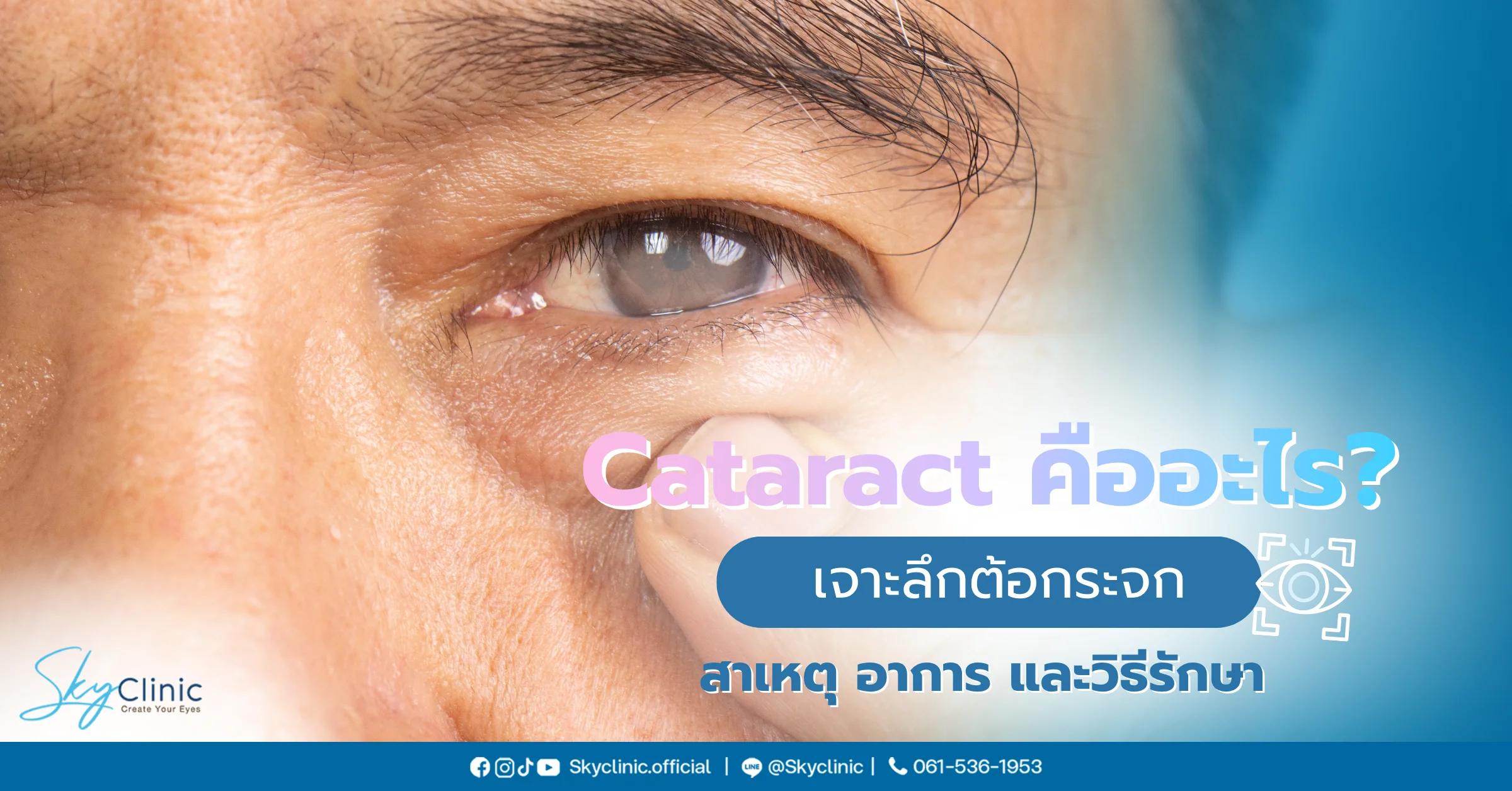 ต้อกระจก