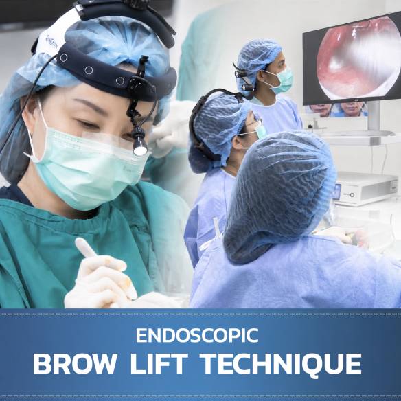 Endoscopic Brow Lift Review