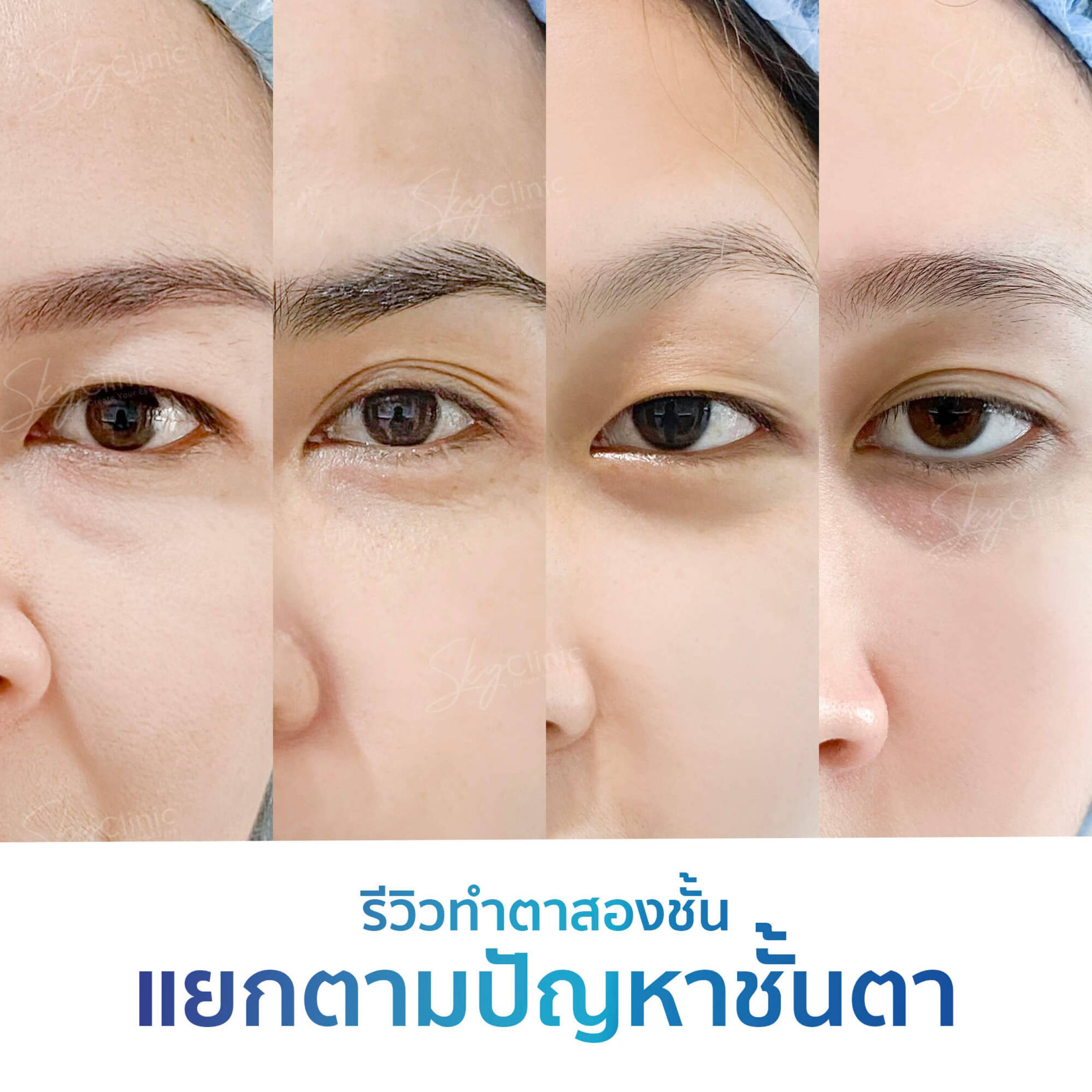 รีวิวทำตาสองชั้นโดยแยกตามปัญหาตา