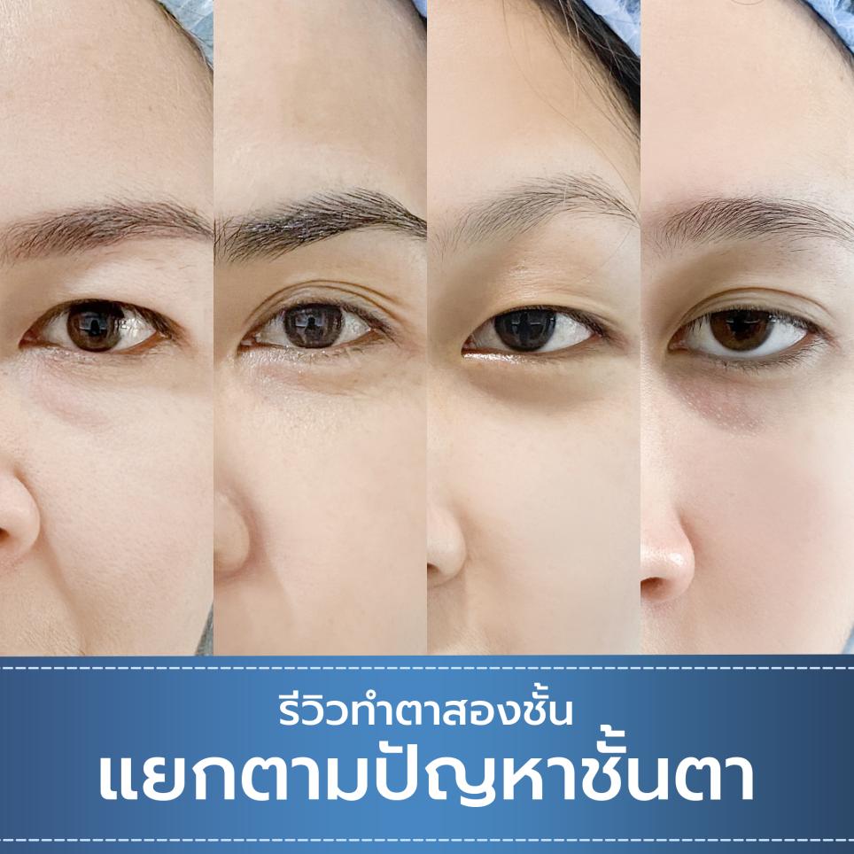 รีวิวทำตาสองชั้นโดยแยกตามปัญหาตา