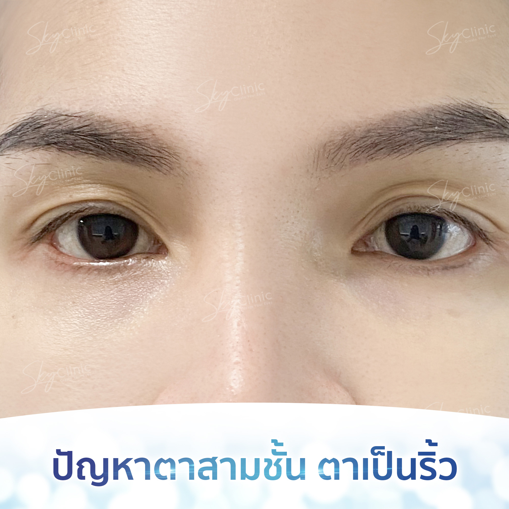 ตาสามชั้น ตาเป็นริ้ว (Multiple creases of eyelid)