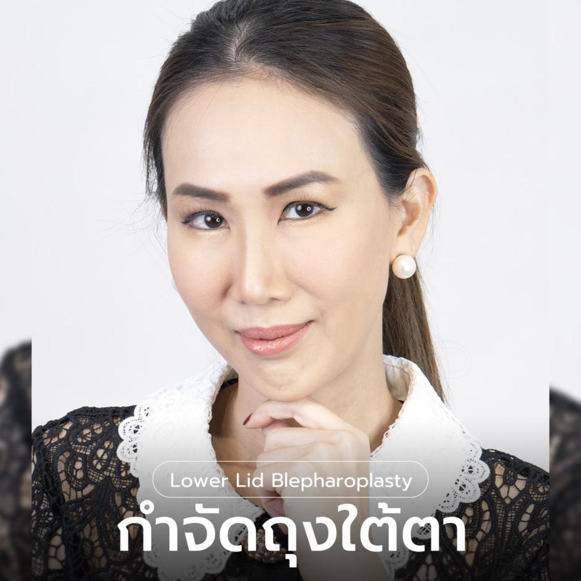 กำจัดถุงใต้ตา และ จัดเรียงไขมัน