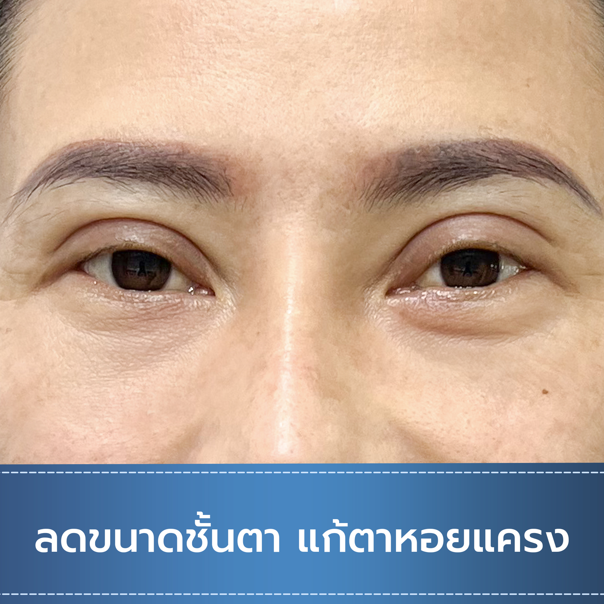 ลดขนาดชั้นตา