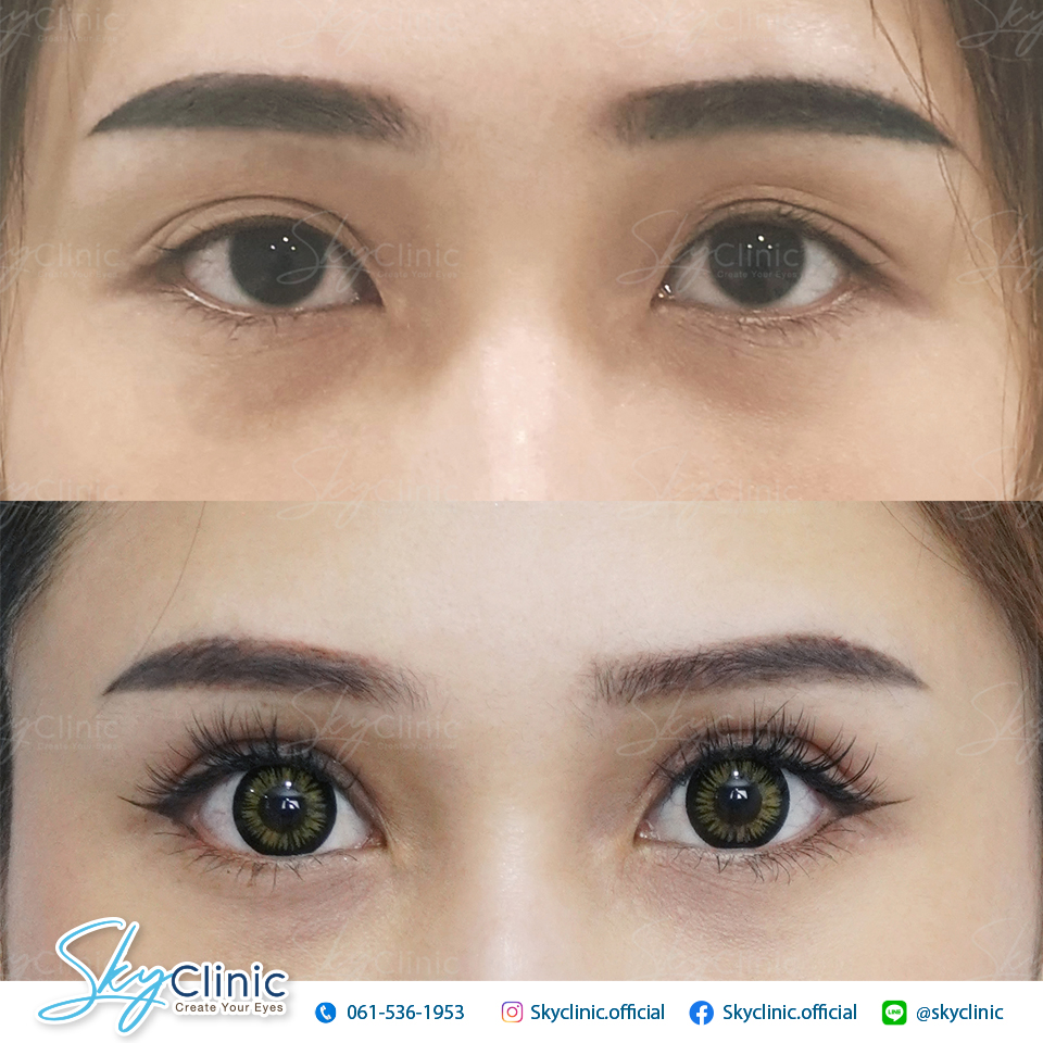 ปรับกล้ามเนื้อตาอ่อนแรง (Ptosis Correction)