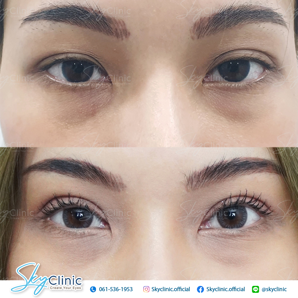 ปรับกล้ามเนื้อตาอ่อนแรง (Ptosis Correction)