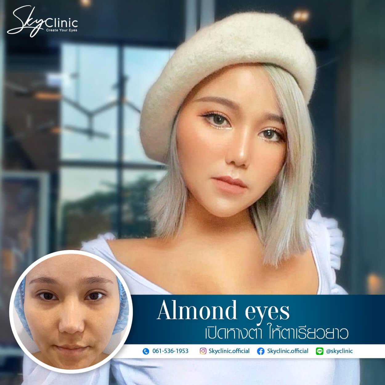 เปิดหางตา ( Lateral Canthoplasty )
