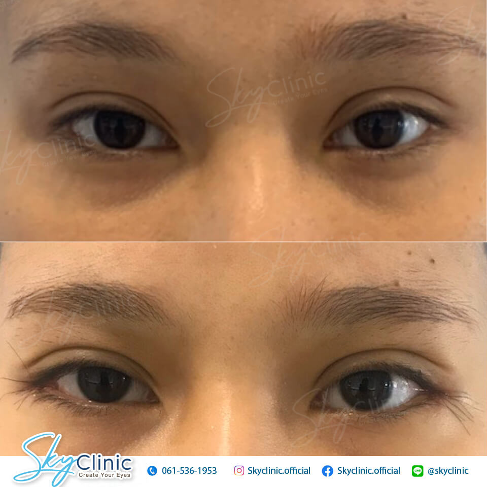เปิดหางตา ( Lateral Canthoplasty )