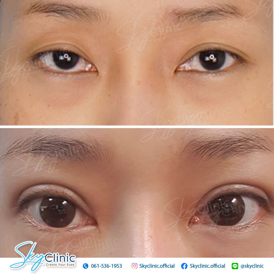 ปรับกล้ามเนื้อตาอ่อนแรง (Ptosis Correction)