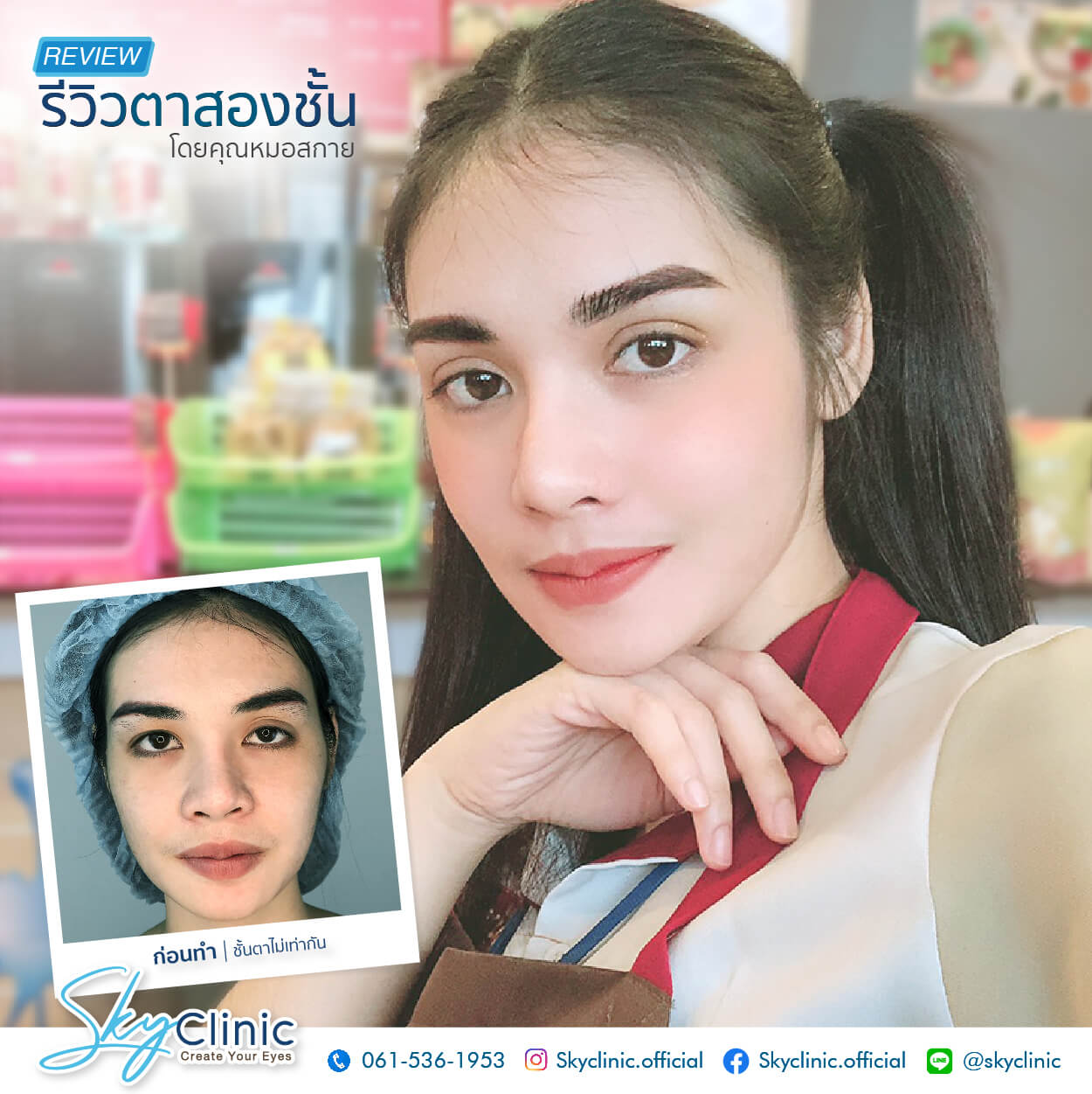 ปรับกล้ามเนื้อตาอ่อนแรง (Ptosis Correction)