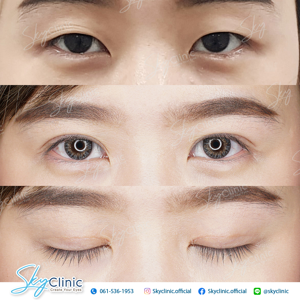 ทำตาสองชั้นแผลเล็ก (Mini-Blepharoplasty) - Sky Clinic ทำตาสองชั้น หมอสกาย โดย จักษุแพทย์