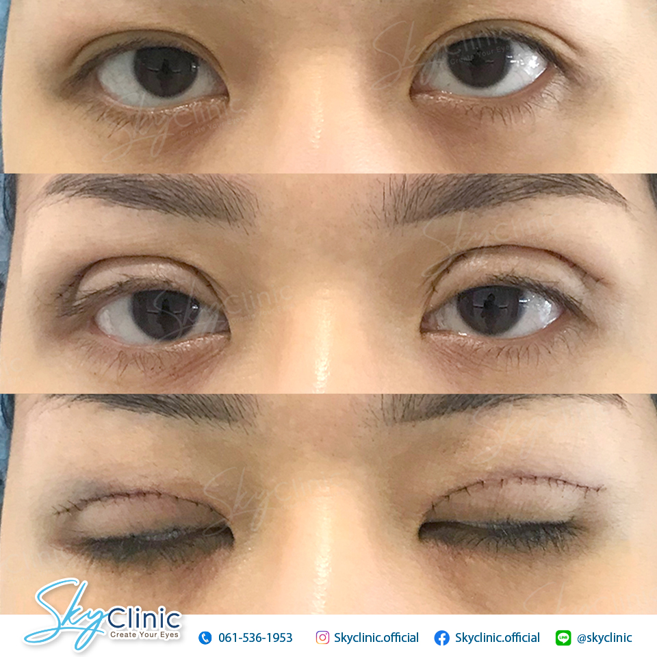 ทำตาสองชั้น กรีดยาว ตกแต่งหนังตา (Upper lid blepharoplasty)