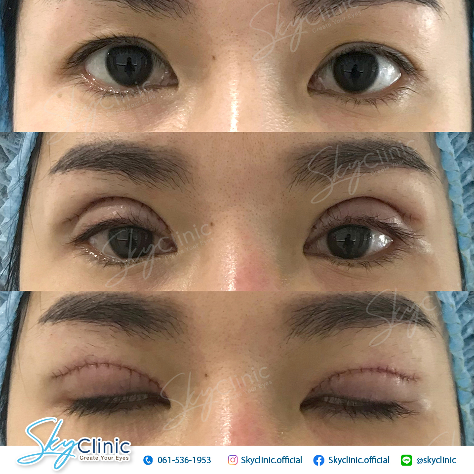 ทำตาสองชั้น กรีดยาว ตกแต่งหนังตา (Upper lid blepharoplasty)