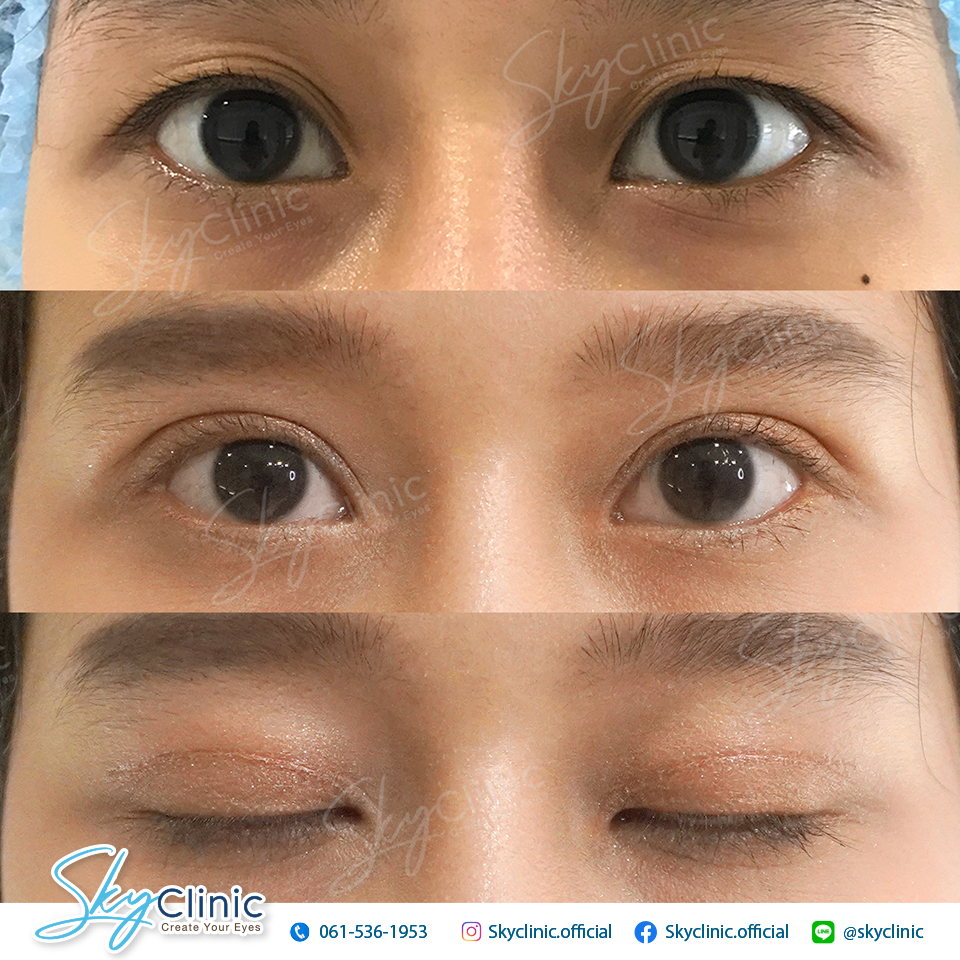 ทำตาสองชั้น กรีดยาว ตกแต่งหนังตา (Upper lid blepharoplasty)