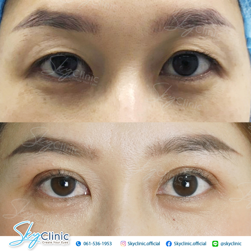ทำตาสองชั้น กรีดยาว ตกแต่งหนังตา (Upper lid blepharoplasty)