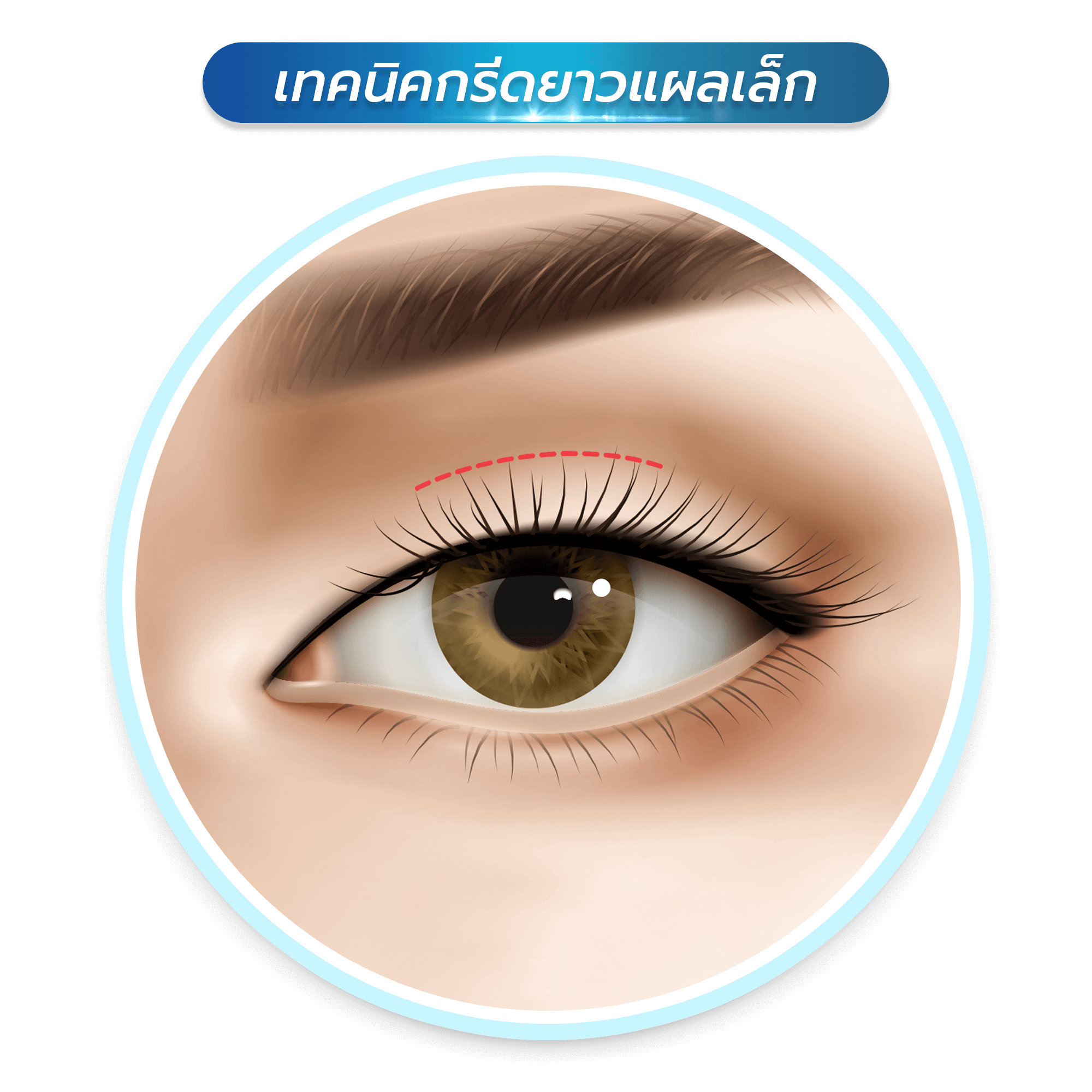 ทำตาสองชั้น กรีดยาวแผลเล็ก