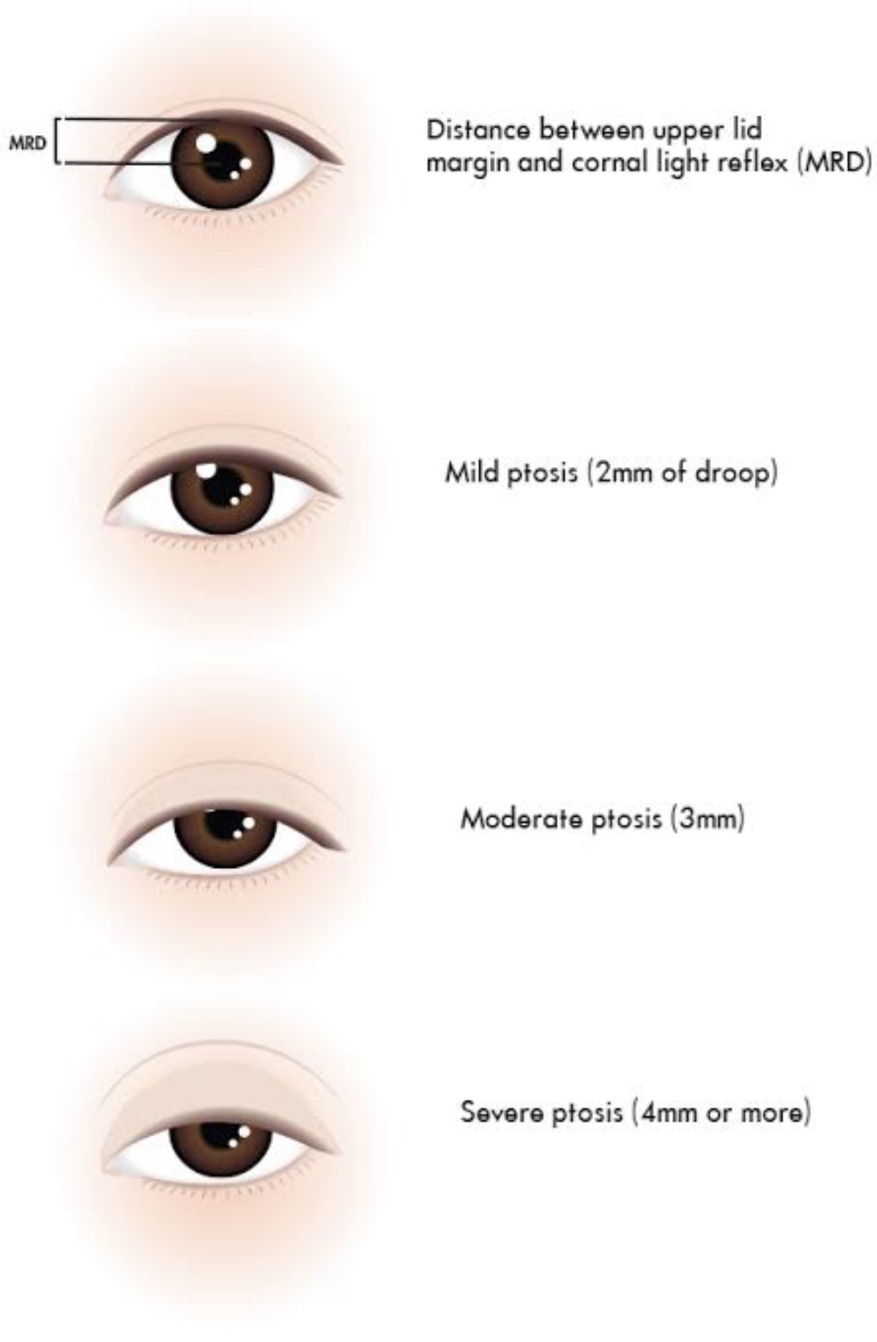 Pseudo-Ptosis