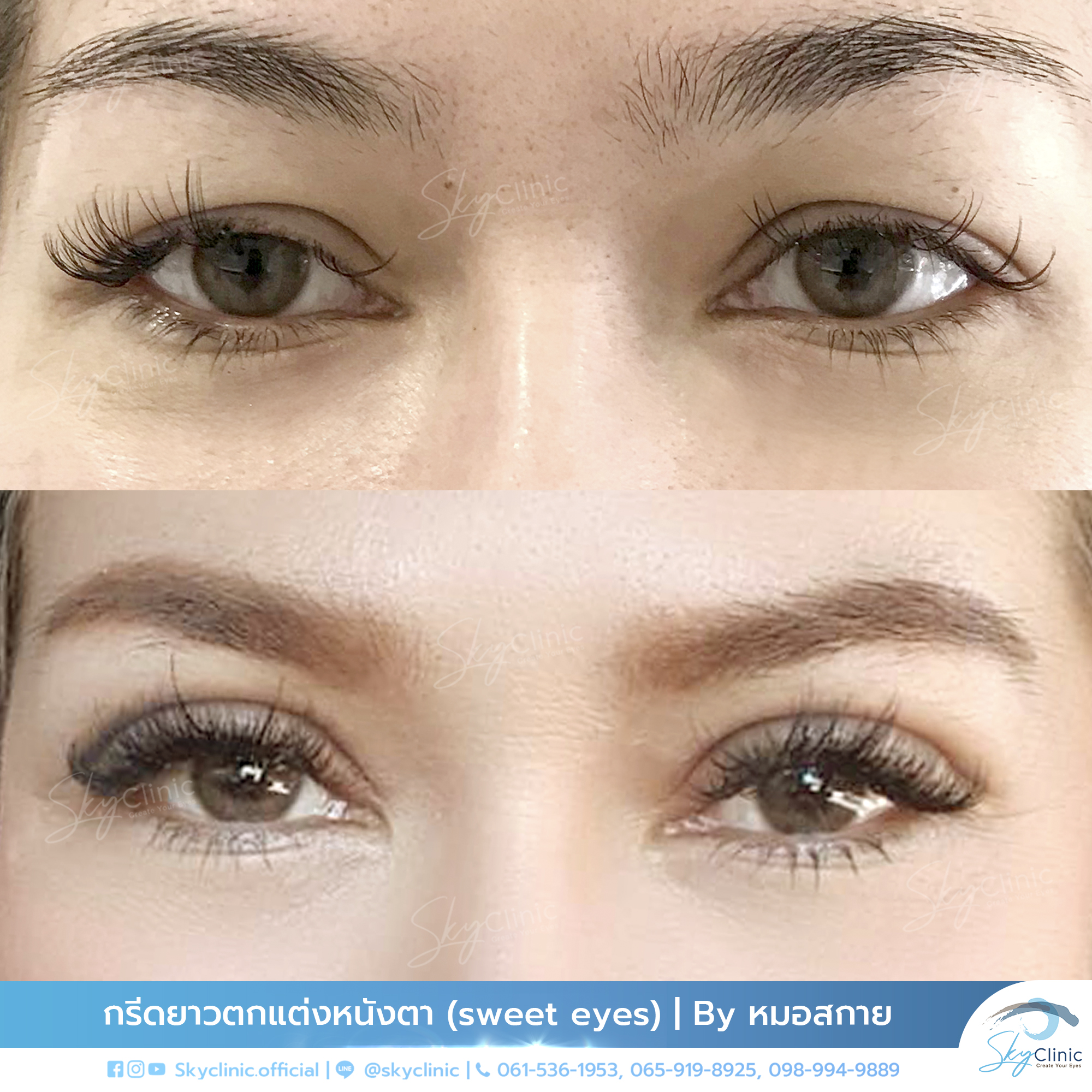Under-Eye Bags